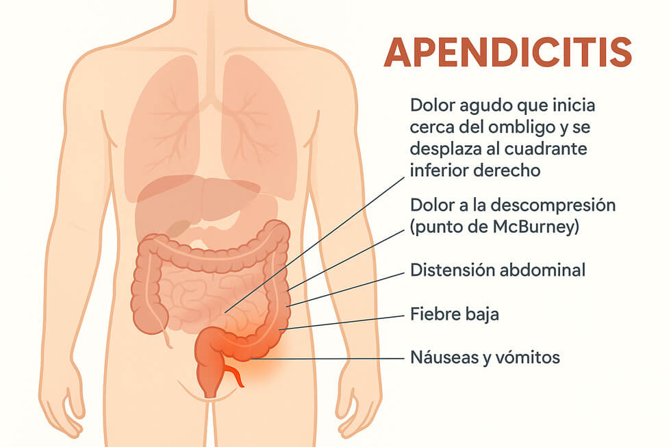 Ilustración médica detallando la ubicación del apéndice y los principales síntomas de apendicitis que se manifiestan en el abdomen.